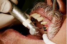 Teeth Drilling