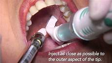 Injector Gp Injector