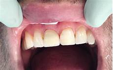 Teeth Used
