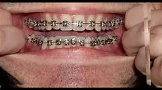 Teeth Used