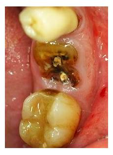 Tooth